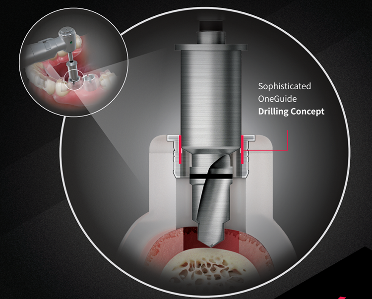 OGSCR  Osstem Guide Hole Sleeve